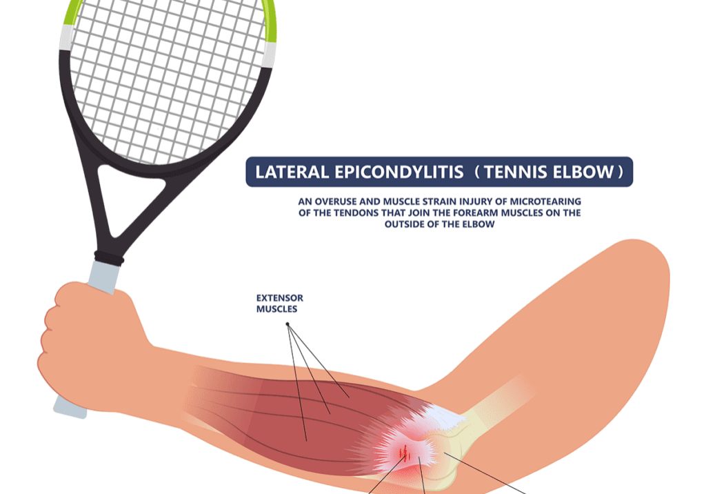 Tennis-elbow-1